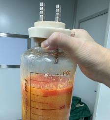 攀枝花水动力吸脂手术要做多久？